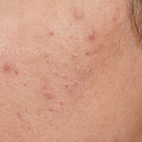 Pigmentation and melasma marks